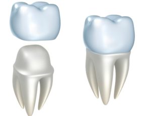 rendering of dental crowns