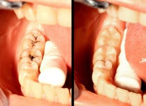 amalgam fillings replaced with composite fillings