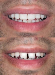 man before and after dental bonding treatment
